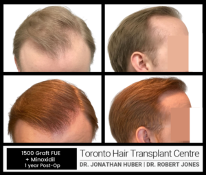 1500 GRAFT FUE BEFORE AND AFTER