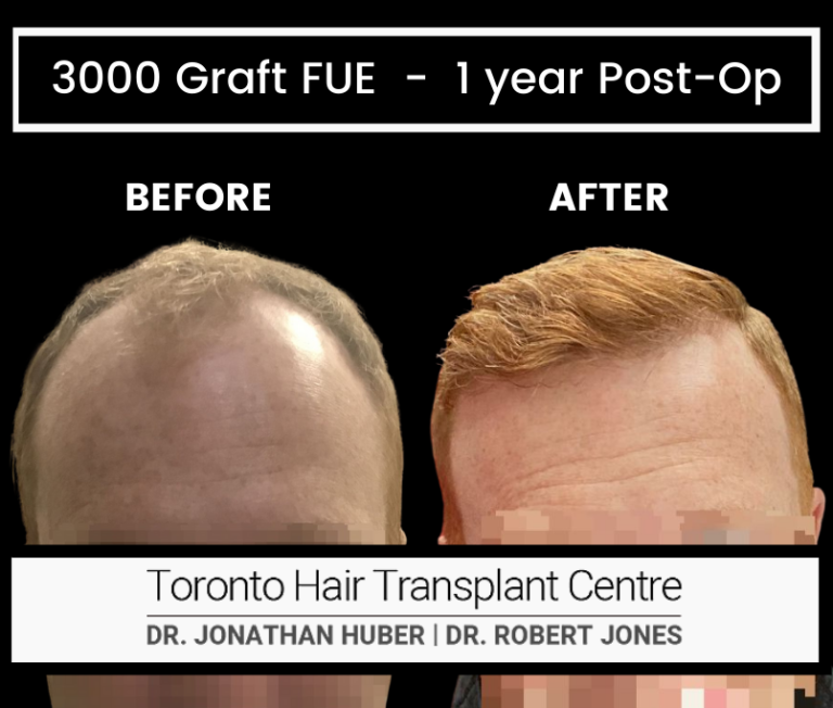 Results Archive | Toronto Hair Transplant Centre