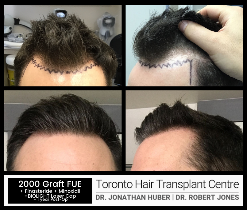 Before And After - 2000 Grafts FUE - Toronto Hair Transplant Centre