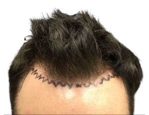 BEFORE - 40 yr M 2000 graft FUE