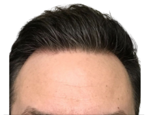 40 yr M 2000 graft FUE + Minoxidil + Finasteride+BIOLIGHT