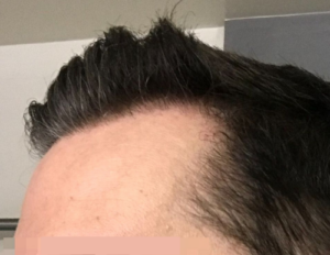 40 yr M 2000 graft FUE (S)+ Minoxidil + Finasteride + BIOLIGHT