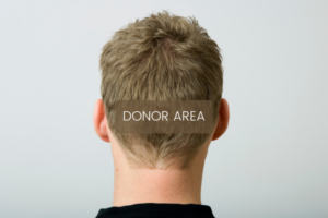 Hair Loss in 20's and 30's - Donor Area