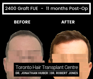 47 yr Male Before and After 2400 Graft FUE