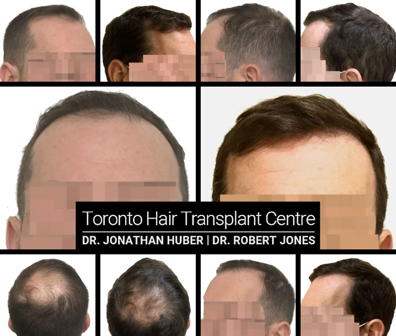 FUE Before and After - 47 yr old Male - 2400 grafts