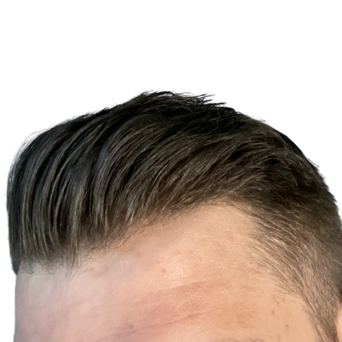 FUE - 1500 Grafts + Finasteride