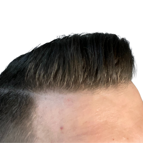 FUE - 1500 Grafts + Finasteride