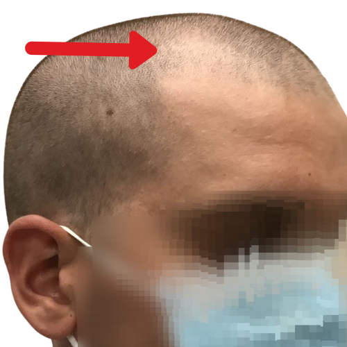 FUE - 1500 Grafts + Finasteride