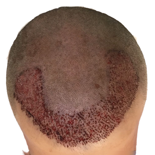 FUE - 1500 Grafts immediately post-op