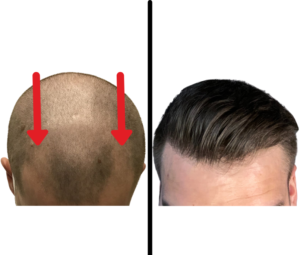 FUE - 1500 Grafts + Finasteride