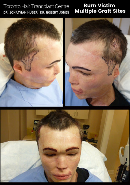 Burn Victim - Multiple Site Hair Restoration