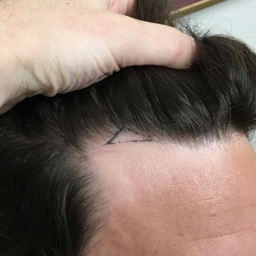 No-Shave FUE - 50 Grafts - Before Surgery