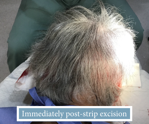 THTS - FUT Post-Strip Excision