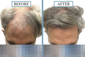 Before and After – 2091 Graft FUT