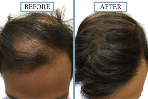 Before and After – 2250 Graft FUT