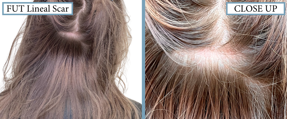 Before and After - Post FUT - Lineal Scar is almost Invisible