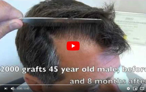 2500 Hair Grafts Before and After