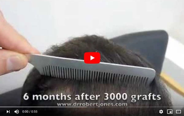 3000 Graft Hair Transplant Before and After