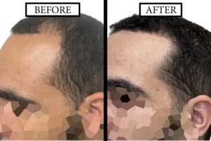 THTC Before and After 3000 GraftFUE
