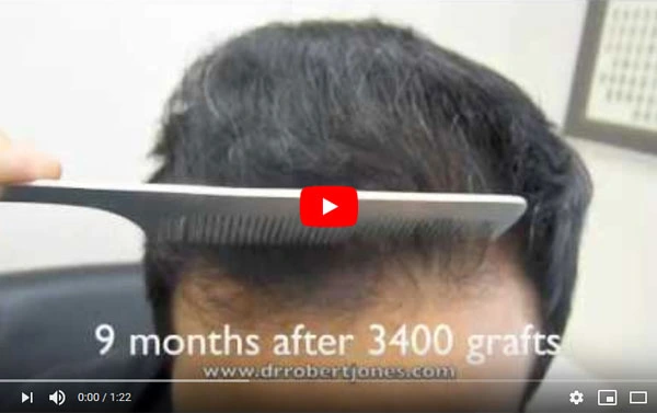 Hair Restoration Surgery of 3400 Grafts