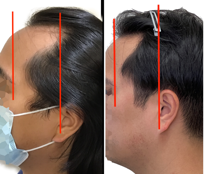 Hair Transplant Results Toronto Hair Transplant Surgeons