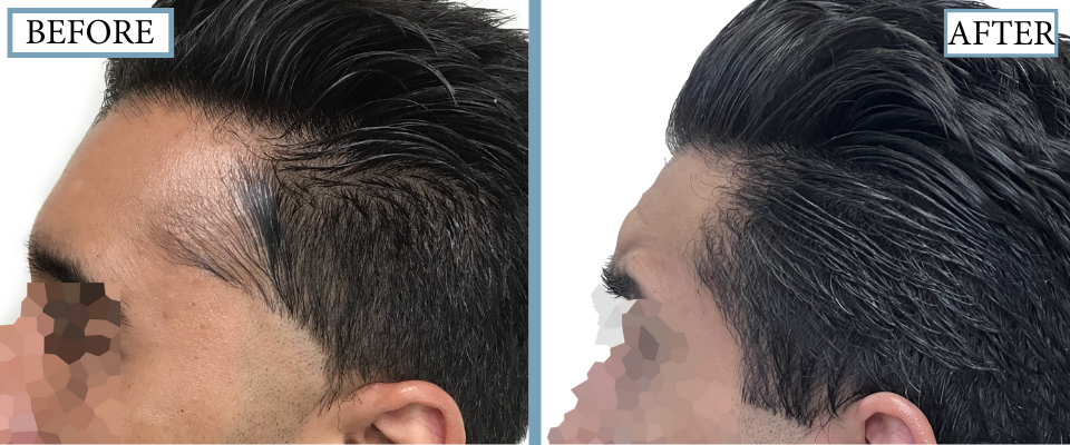 THTC Before and After FUE