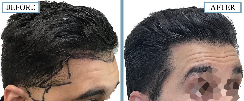 THTC Before and After FUE
