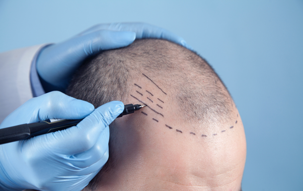 hair transplant toronto - toronto hair transplant centre