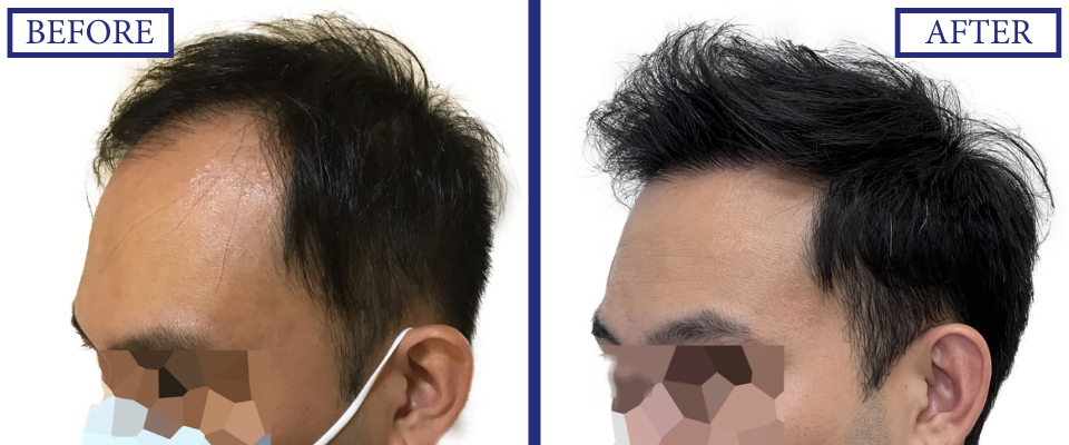 THTS Before and After FUE