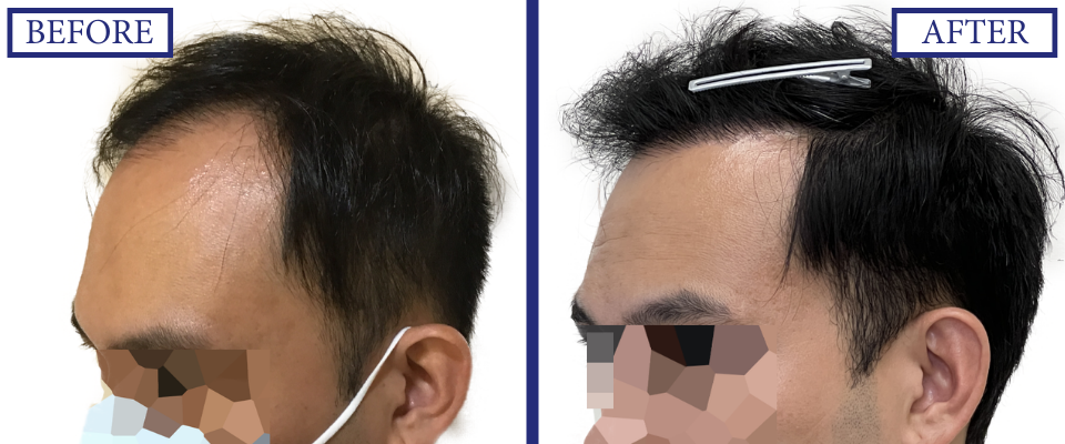 THTC Before and After FUE
