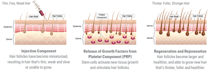 PRP for Hair Follicles