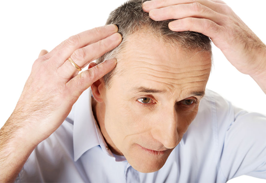 Hair Loss in Men