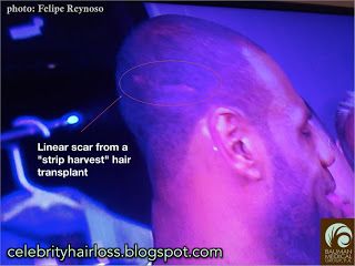 Lebron James’ Hair Transplant Treatment