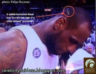 Lebron James’ Hairloss