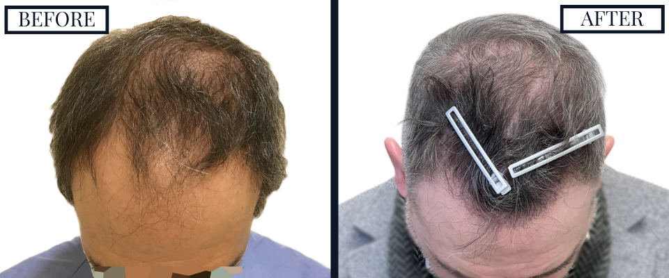 THTS 2500 Graft FUE Before and After