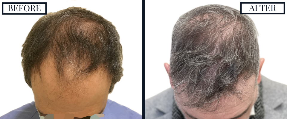 THTS 2500 Graft FUE Before and After