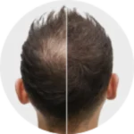 Our Results - Hair Transplant