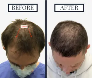 Professional Hair Transplant Procedure