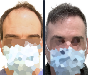 Solutions For Hair Restoration