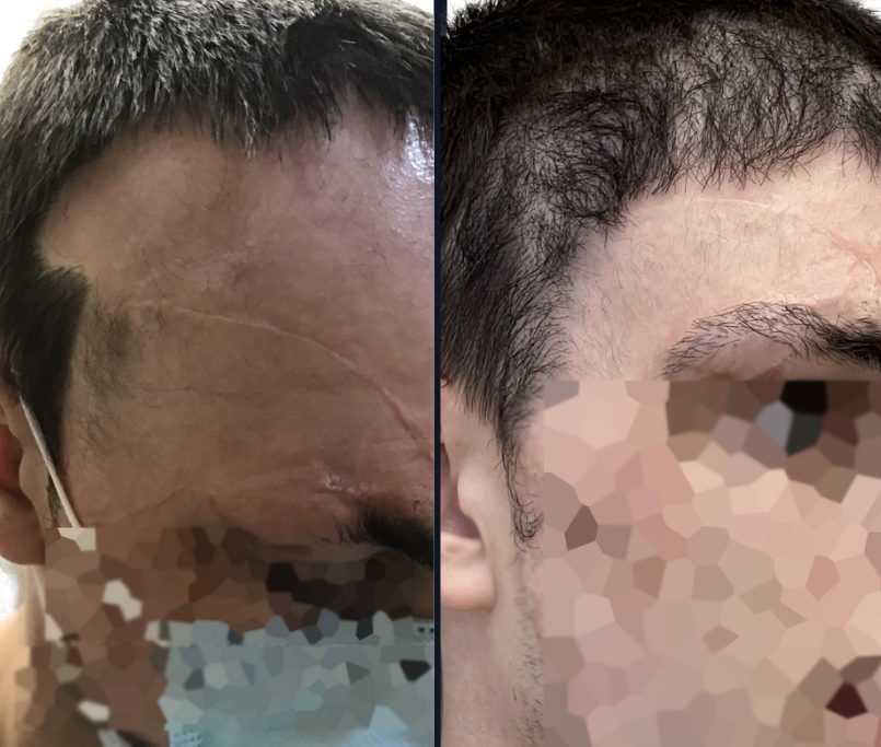 Hair Transplant Results - Toronto Hair Transplant Surgeons