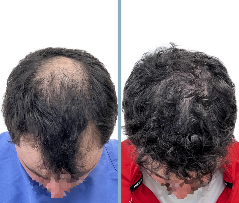 Hair Transplant Results - Toronto Hair Transplant Surgeons