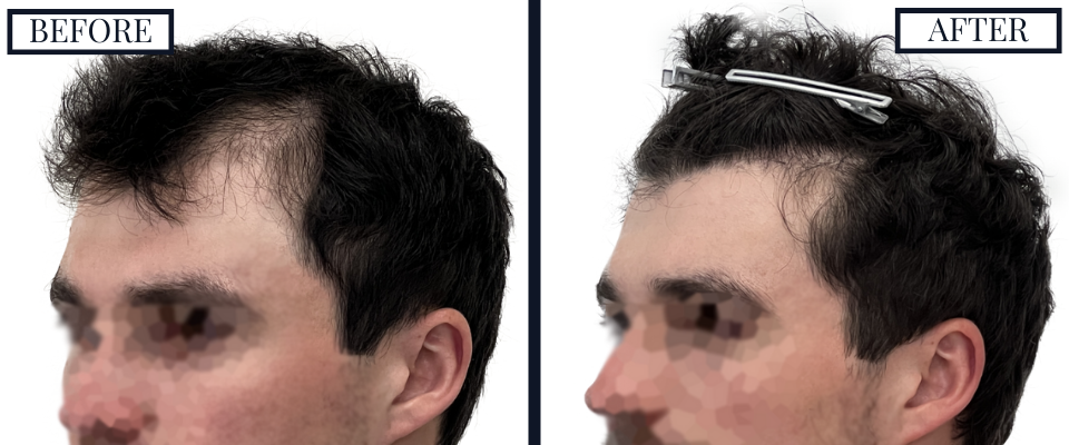 2023 Graft FUE Left View before and after