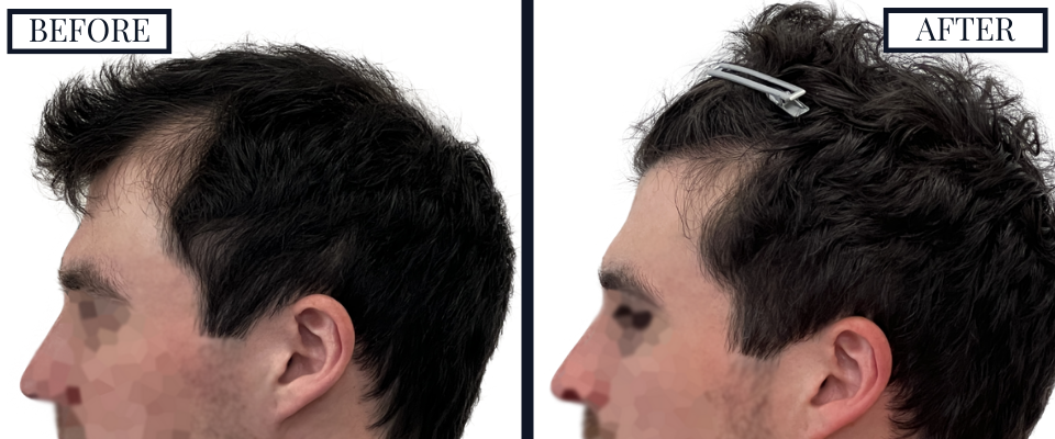 2023 Graft FUE Before and After Left View