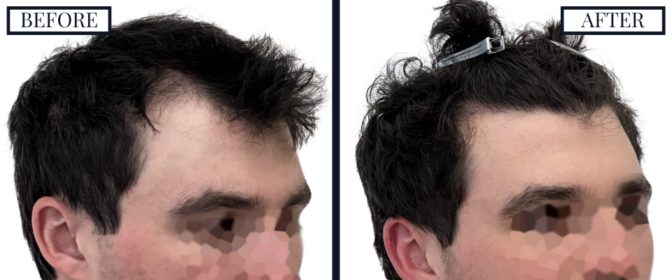 2023 Graft FUE Before and After Right Oblique View