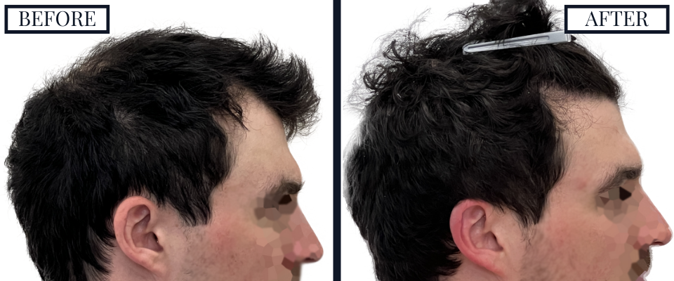 2023 Graft FUE Before and After Right Side View