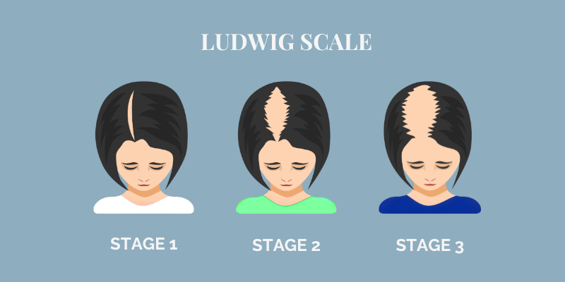 LUDWIG SCALE - Hair Loss in Women