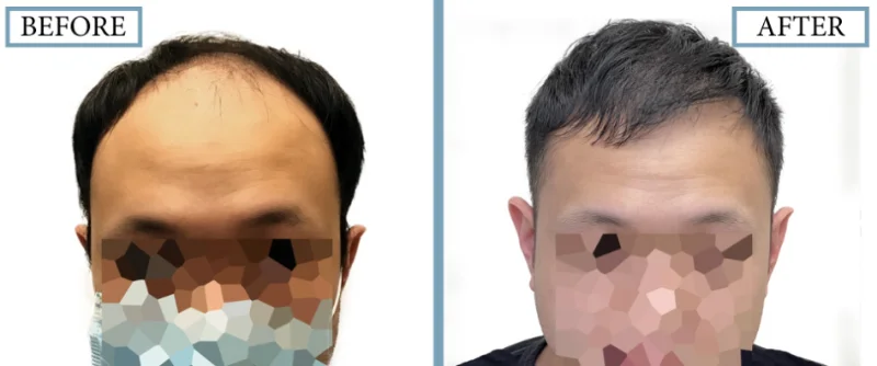 Before and After Hair Transplant Result