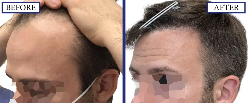 Before and After Hair Restoration Result