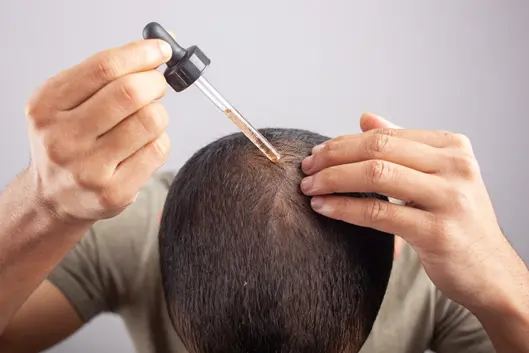 Minoxidil Hair Growth Treatment