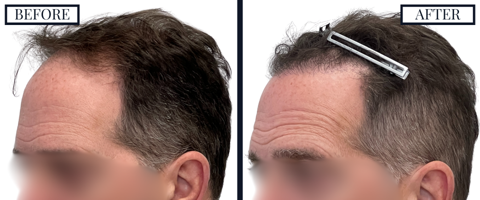 3059 FUE - Before and After Left Oblique View